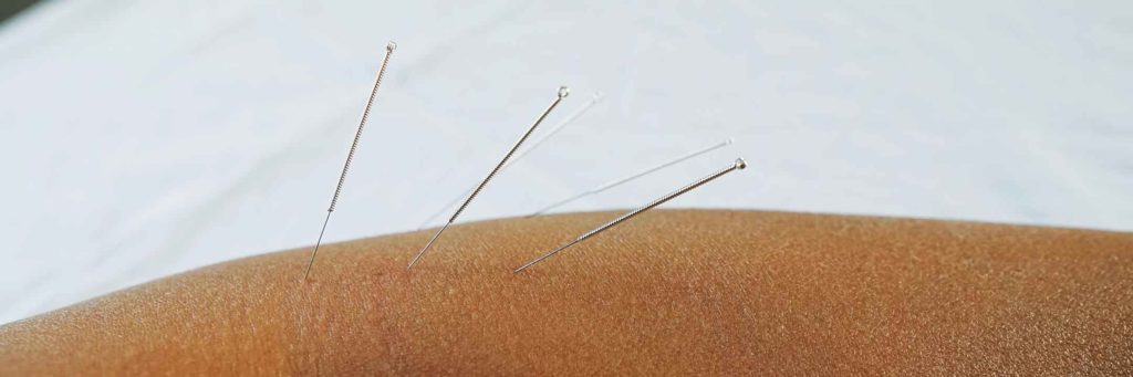 Acupuncture needles placed in arm of patient show the gentleness of the needles.
